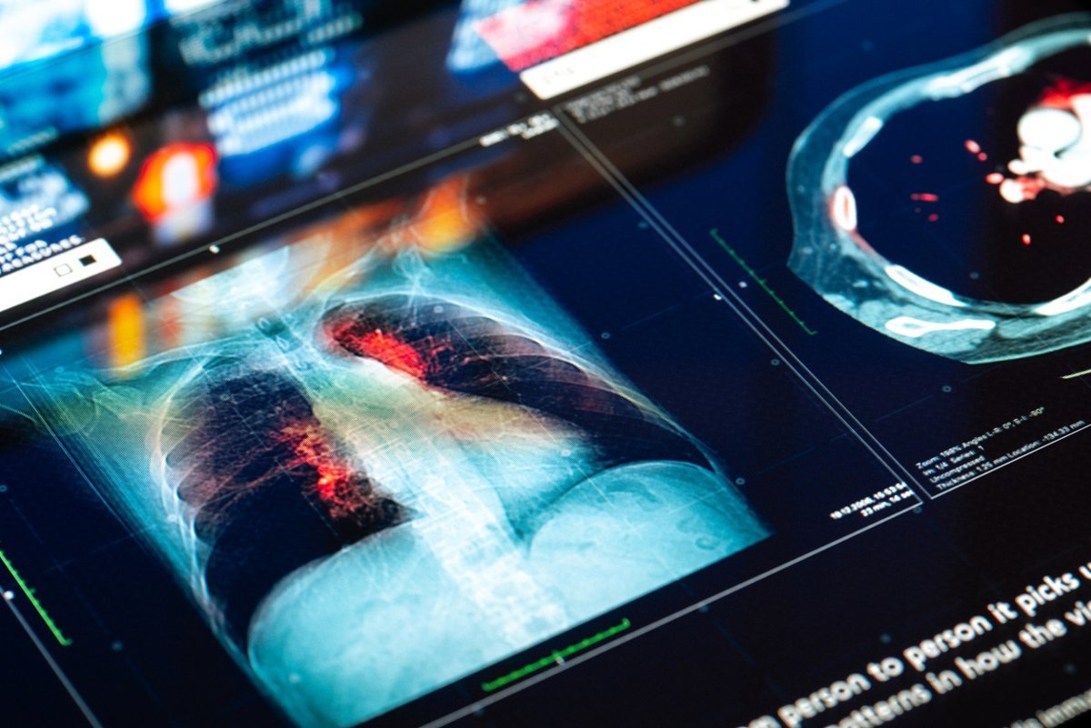 Un nuevo conjugado de anticuerpo y fármaco muestra eficacia prometedora en cáncer de pulmón