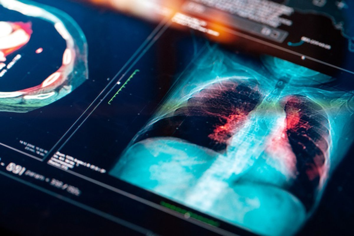 Un modelo de aprendizaje profundo evalúa el riesgo de cáncer en nódulos pulmonares