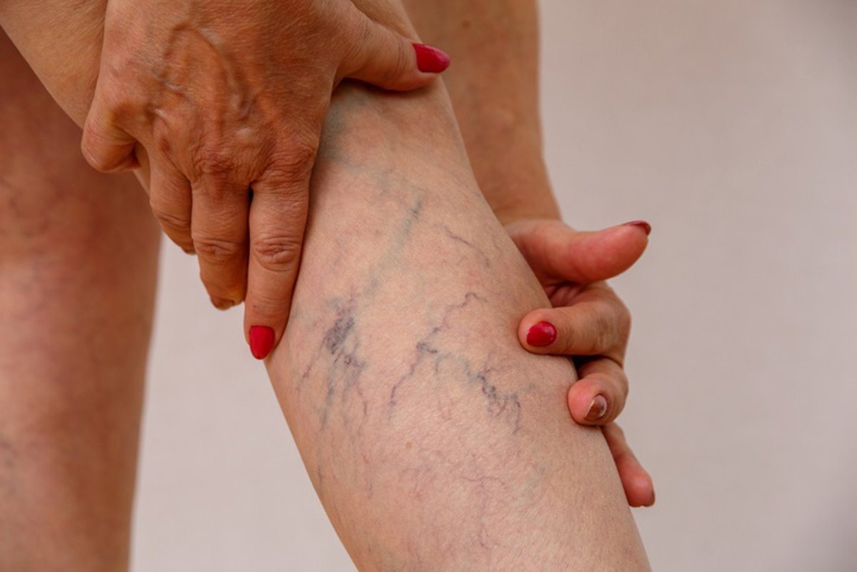 Varices y arañas vasculares: ¿simple cuestión estética o implican riesgo cardiovascular?
