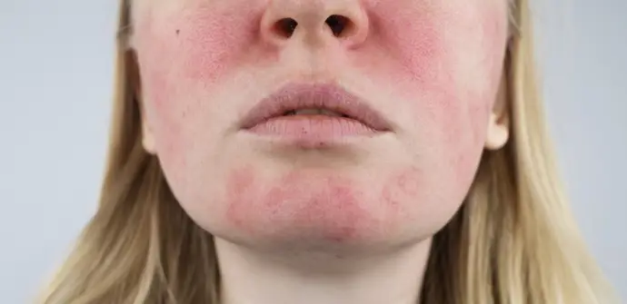La rosácea es más que enrojecimiento: dermatólogos advierten sobre su inflamación y efectos si