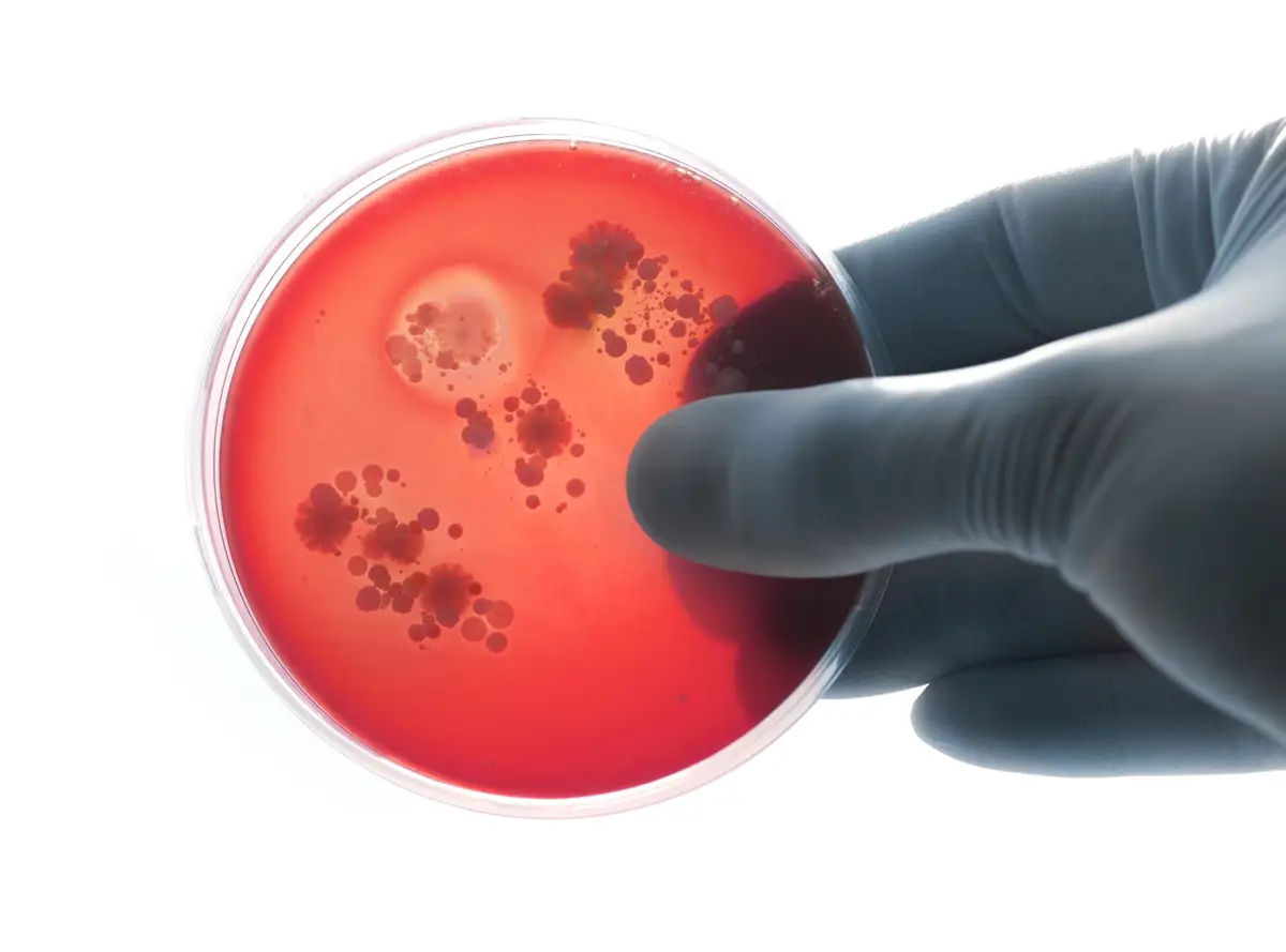 La meningitis continúa siendo un problema mundial: más de 250.000 muertes en 2023 a pesar de las