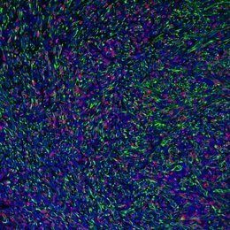 Archivo - Tumor con c&eacute;lulas cancerosas deficientes en FMRP (en verde) que son infiltradas y adheridas por c&eacute;lulas T asesinas (CD8).