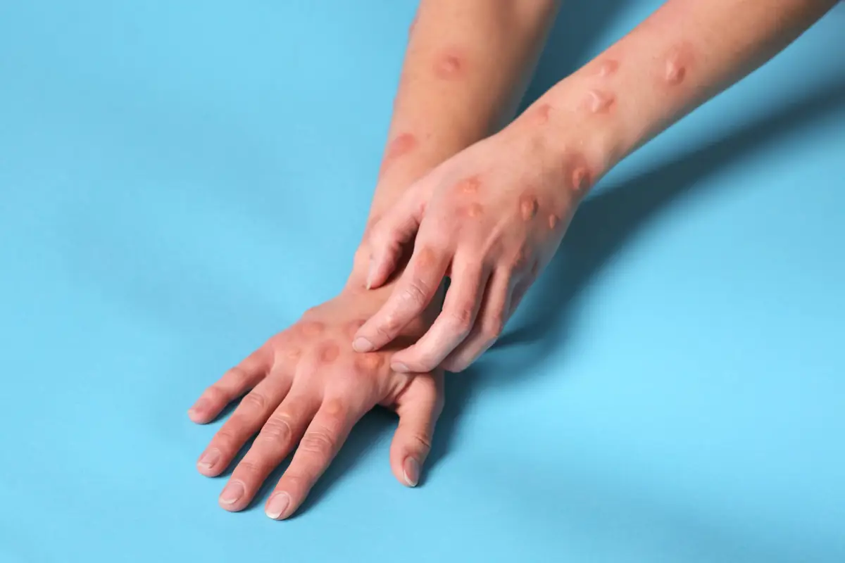 La ruta de contagio de mpox podría evolucionar de sexual a familiar con el tiempo